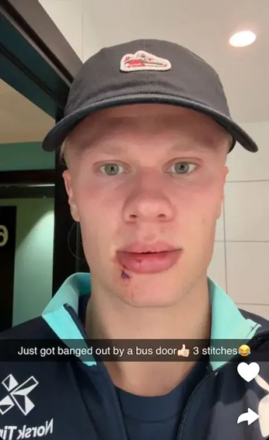 Close-up of a young man with a cut lip, stating he received three stitches after being hit by a bus door.