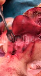 Close-up of a surgical procedure on a person's face.