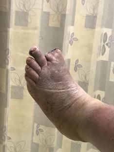 Amputated big toe with infection.