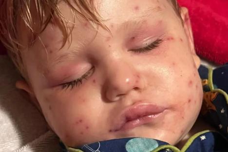 Boy, 2, born with one kidney fights for life after being stung 150 times by wasps when he bumped into nest on toy car