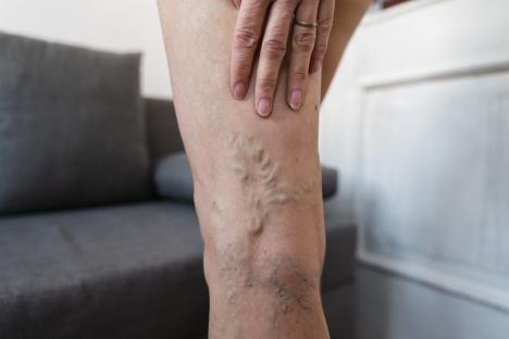 Close-up of varicose veins on a woman's leg.