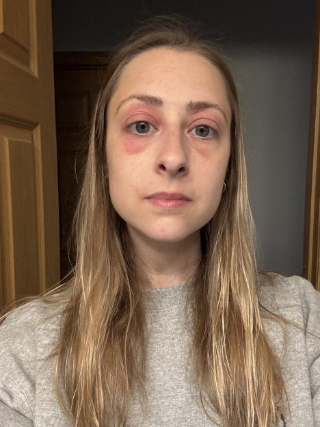 Woman with red, swollen eyes.