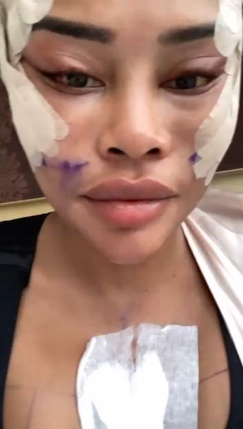 Video grab of Jade during recovery with white bandages on her face, marks on her chest, and purple markings on her jawline.