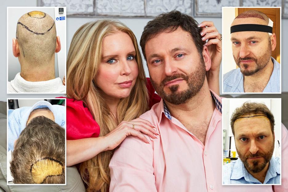 I Scrapped My Bathroom Renovation to Fund My Husband's Two Hair Transplants in a Year—Now He's Addicted to the Mirror!