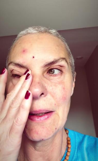Close-up of Tracy Shaw, who has red marks on her face, demonstrating chemotherapy side effects.