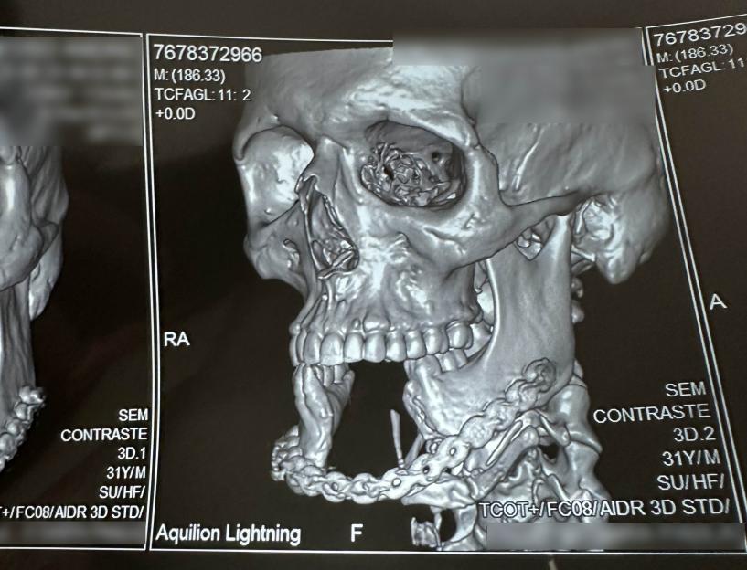 X-ray of André Gayoso's jaw after reconstruction.