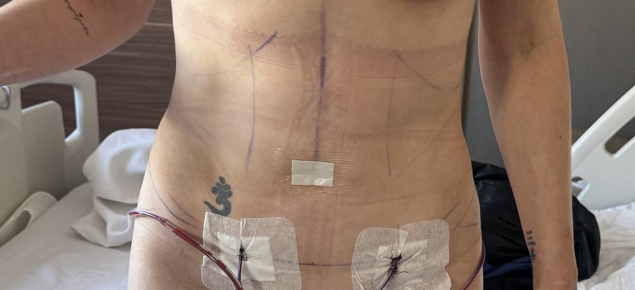A person's midsection and thighs with surgical markings, bandages, and drainage tubes.