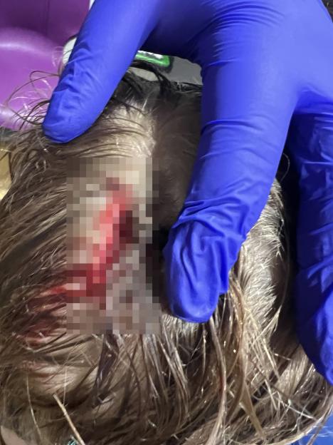A child's head with a dog bite wound, partially covered by hair and a gloved hand.