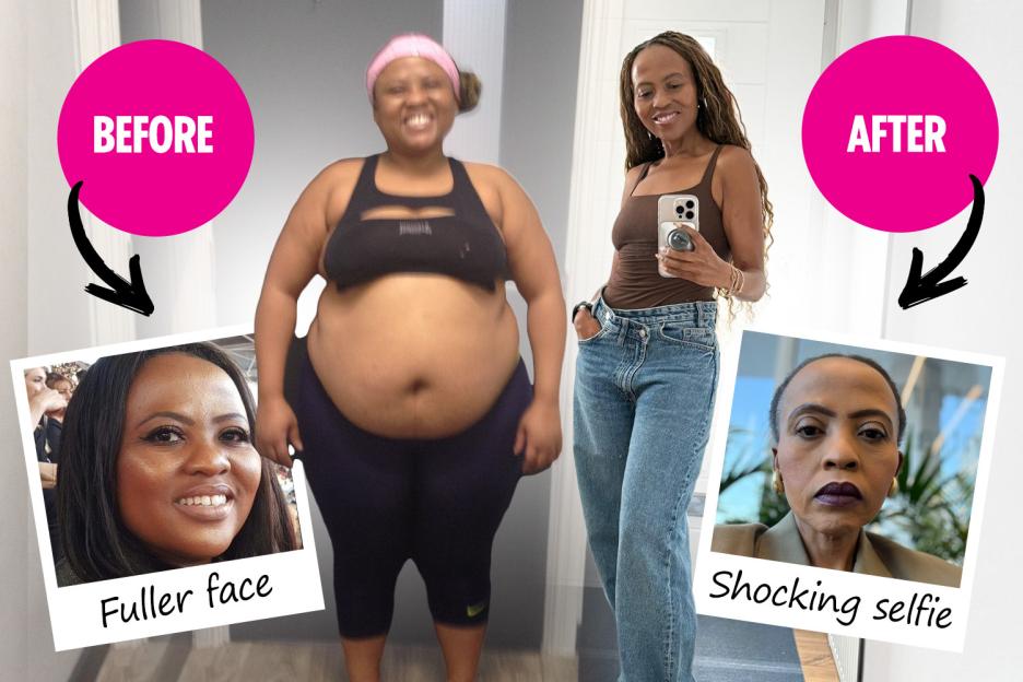 'I Shed an Incredible 11 Stone, But My Weight Loss Added 20 Years—How a New Treatment Restored My Youthful Glow!'