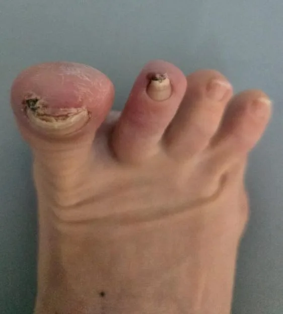 Close-up of a foot showing discolored and damaged toenails.