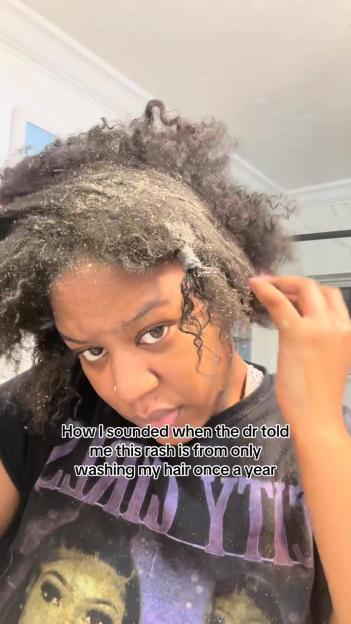 'I Went Viral for Not Washing My Hair—Now I'm Facing Shocking Consequences, Including Bugs Falling Out!'