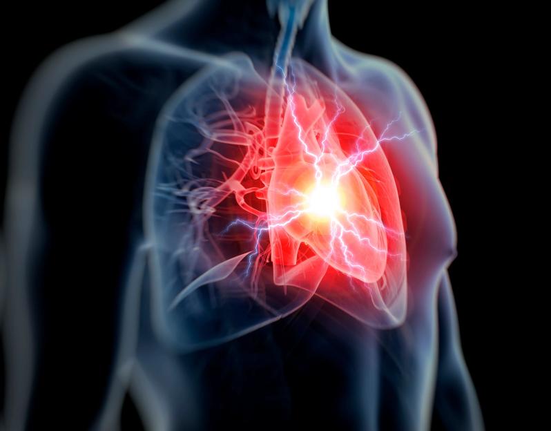 Human heart attack, illustration