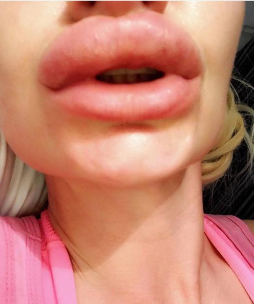 Close-up of a woman's face showing severely swollen lips after a botched lip filler procedure.