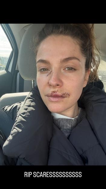 Paige Spara in a car wearing a black puffer jacket, with stitches around her nose and mouth, presumably from a dog attack.