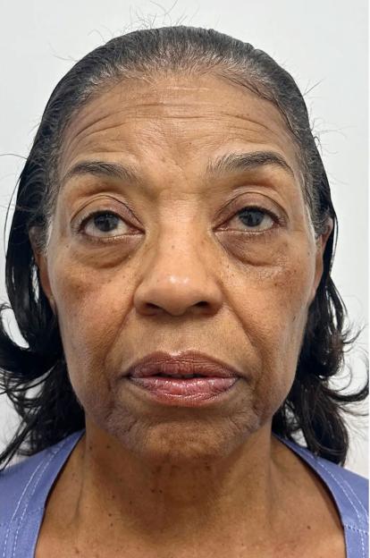 Frontal view of a woman showing periorbital and perioral rhytids, and excess skin of the neck.