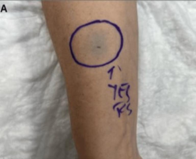 Collage of images showing (A) an arm with a marked area of discoloration, (B) excised tissue with a dark needle track, and (C) a microscopic view of tissue with a dark biopsy track.