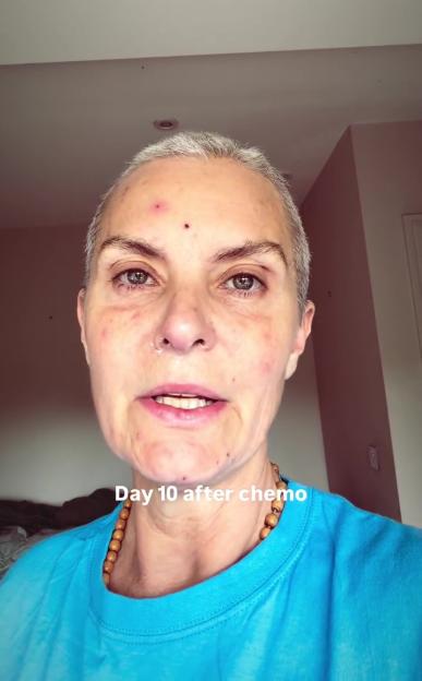 Tracy Shaw shows chemotherapy side effects on day 10 after treatment.