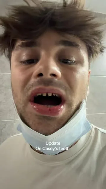 Marnie Simpson’s husband Casey shows off horrific filed-down ‘hillbilly’ teeth ahead of Turkey transformation