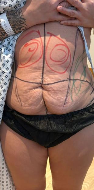 A woman's abdomen marked with black, red, and green lines and swirls for a tummy tuck procedure.