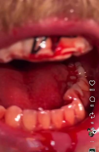 Close up of Jake Paul's mouth with a broken jaw, revealing blood and a medical appliance.