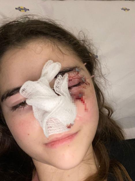 I lost my eye due to a rare cancer  I felt sick to my stomach when I looked in the mirror after surgery