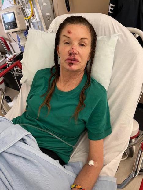 Janice Dickinson in a hospital bed with injuries to her face, including cuts and bruises on her forehead, nose, and lips.
