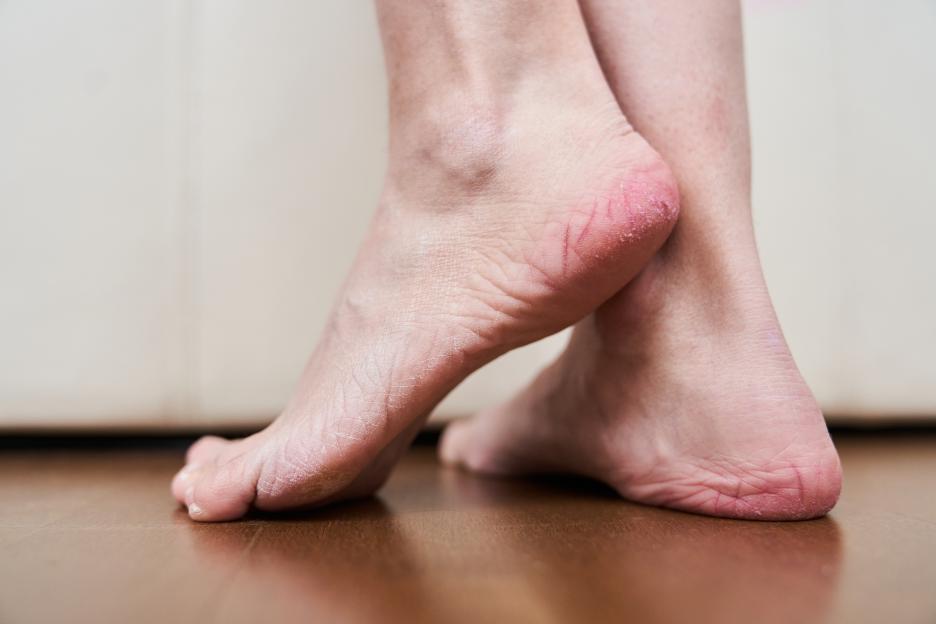 Close-up of bare feet with cracked heels and dry skin.
