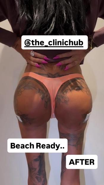 A person's lower back, buttocks, and upper thighs are seen from behind, with "AFTER" at the bottom right.