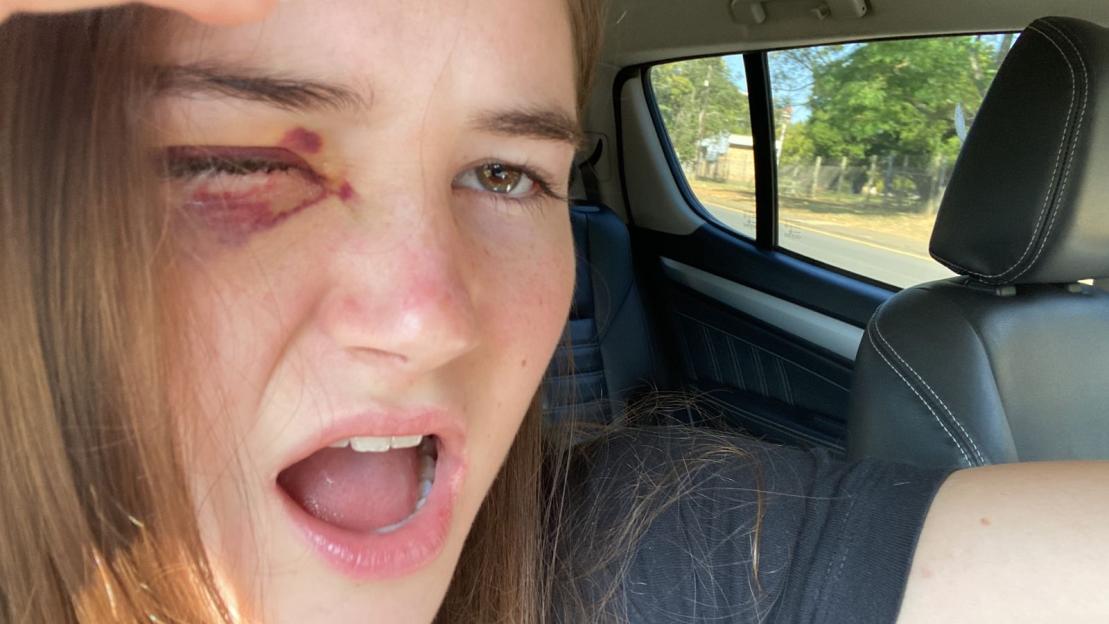 I lost my eye due to a rare cancer  I felt sick to my stomach when I looked in the mirror after surgery