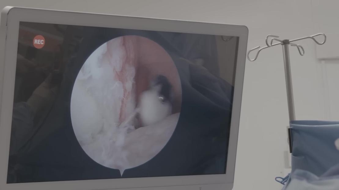 A monitor displaying an internal view of a human joint during surgery.