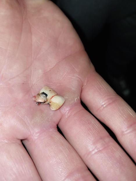 A hand holding two dislodged human teeth, one with blood and exposed nerve.