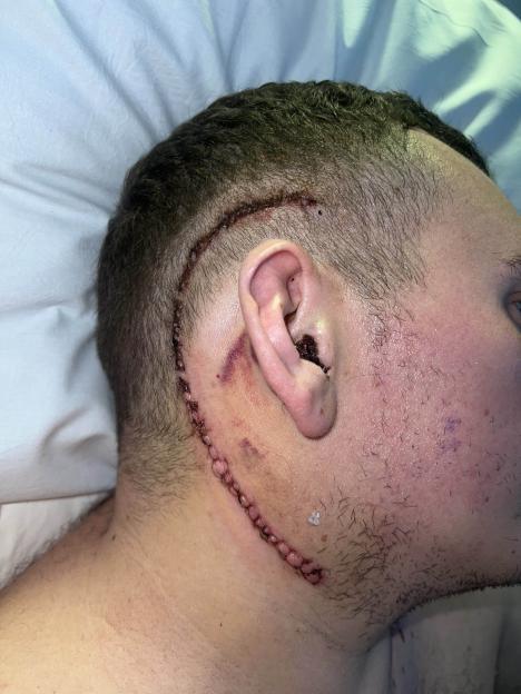 Jake Watts's scar after surgery.