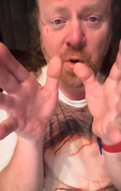 Leigh Francis of Celebrity Juice Unveils Major Scar Following Fan Encounter Gone Wrong