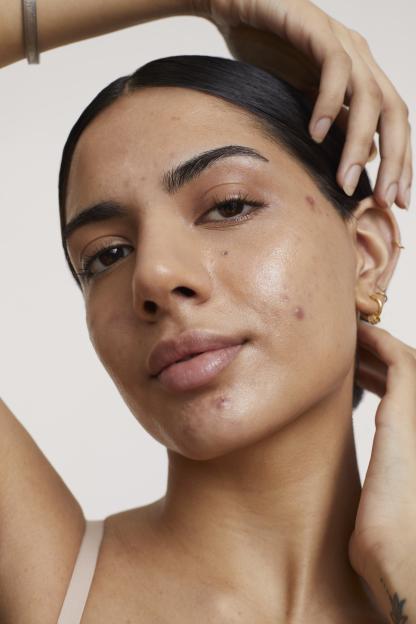 A young woman with visible acne and blemishes on her face looks directly at the camera, with one hand near her ear and the other resting on her head.