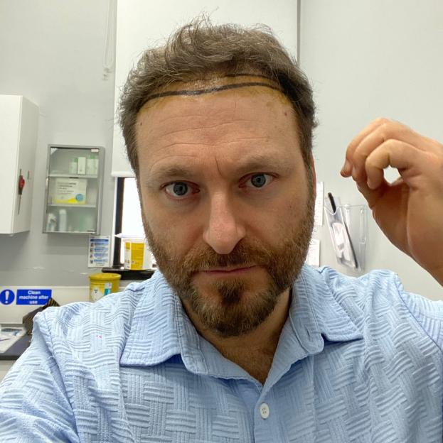 Cornel with a drawn guideline on his forehead for a hair transplant.