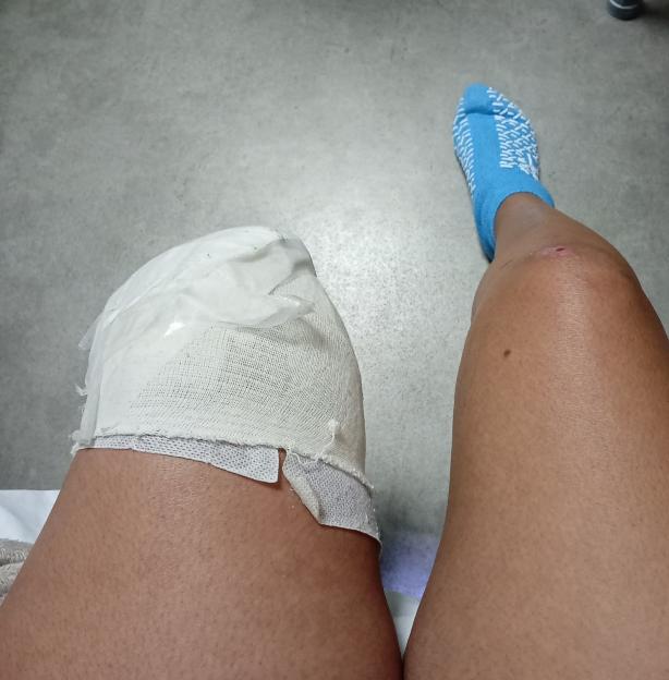 The right leg of a person with a bandaged stump and a blue sock on the other foot.