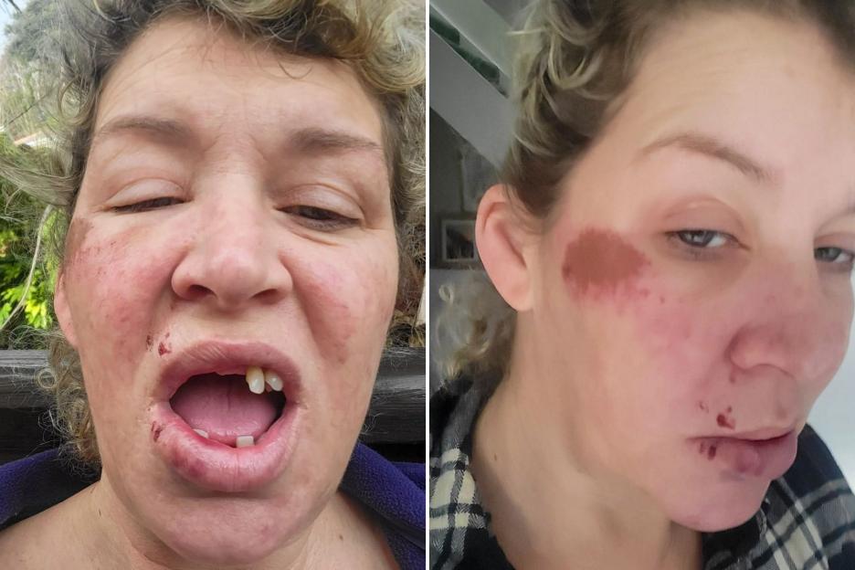 '48-Year-Old Mom Loses Seven Teeth After Falling into Deep Pothole at Night, Council Denies Compensation'