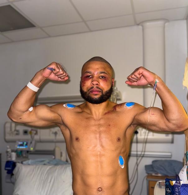 A man with bruises on his face, chest, and arms, and medical sensors on his shoulders and torso, flexes his biceps in a hospital room.