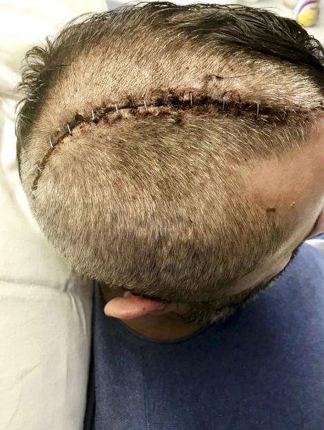 Close-up of a person's head after surgery, showing a surgical incision with staples across the top of their scalp.