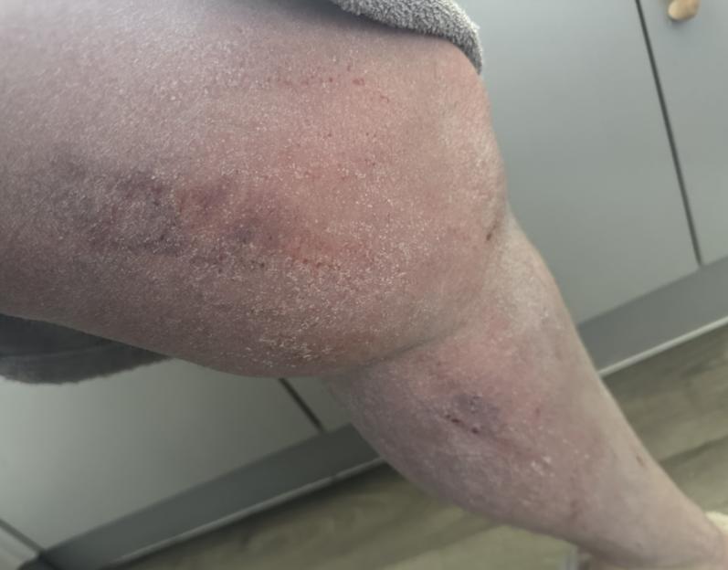 Sophie's leg after extreme itching caused by Topical Steroid Withdrawal.