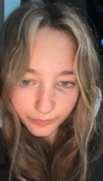 Cleo Lake with a black eye.