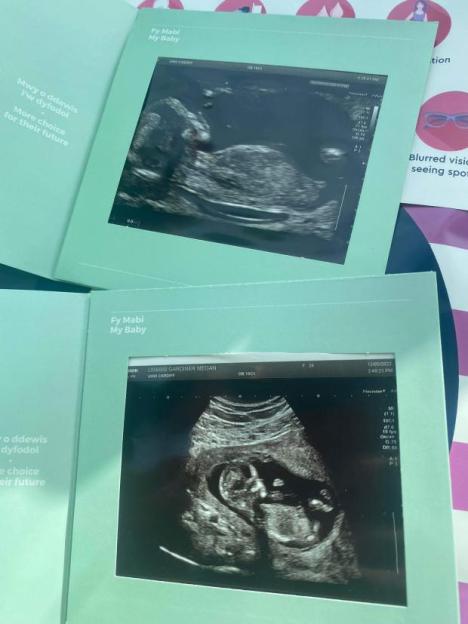 Collage of two ultrasound images of a fetus, one showing a full-body view and the other a side profile.