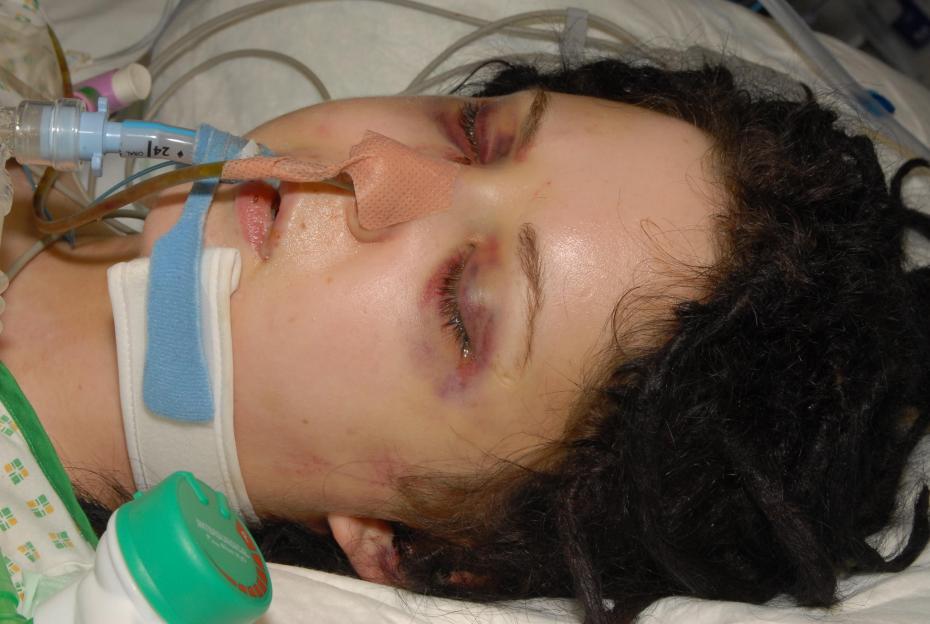 Sophie Lancaster in a hospital bed with an intubation tube in her mouth and a bandage over her nose, with dark bruising around her closed eyes.