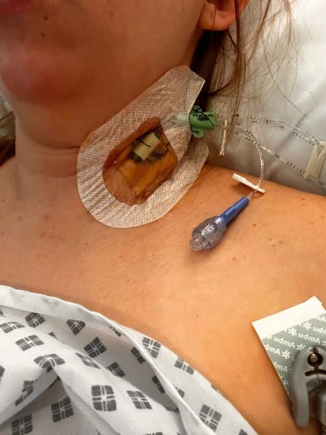 Mum nearly "died" in childbirth after feeling hot as she was being stitched up