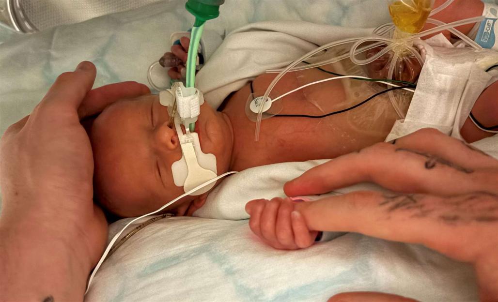 Newborn baby, Luca, in the hospital with a gastroschisis defect, where his bowels developed outside his body.