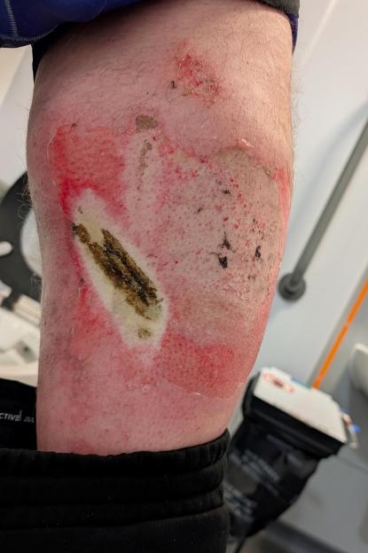 A man's leg with severe burns, exposed skin, and charred fabric from an exploded vape battery.