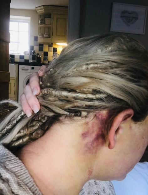 A bruise is visible on the side of Lucy Winter's neck and jaw.