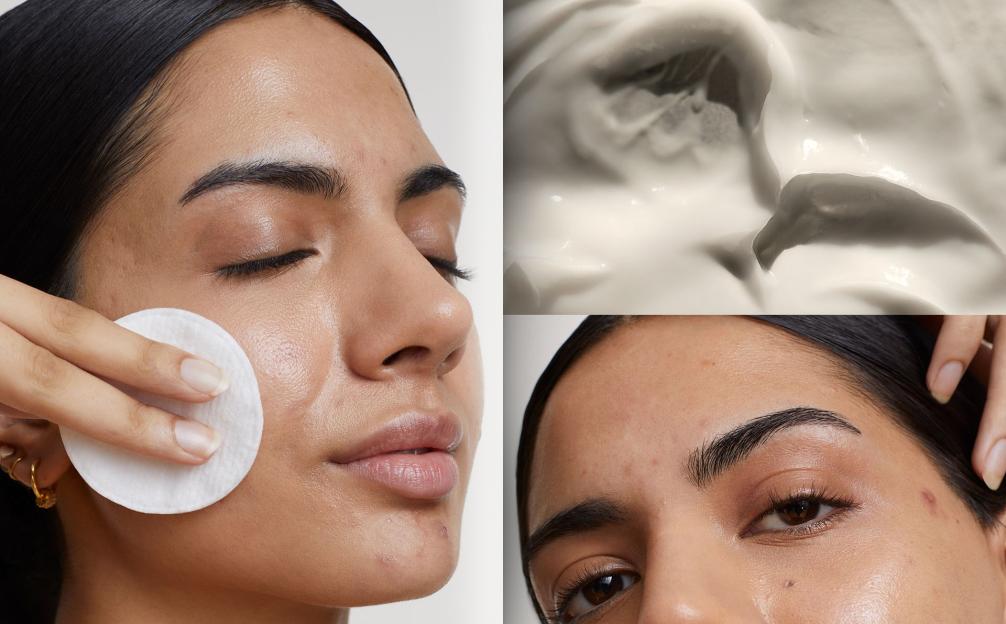 Say Goodbye to Adult Acne: Why Harsh Treatments Could Be Hurting You and What to Try Instead!