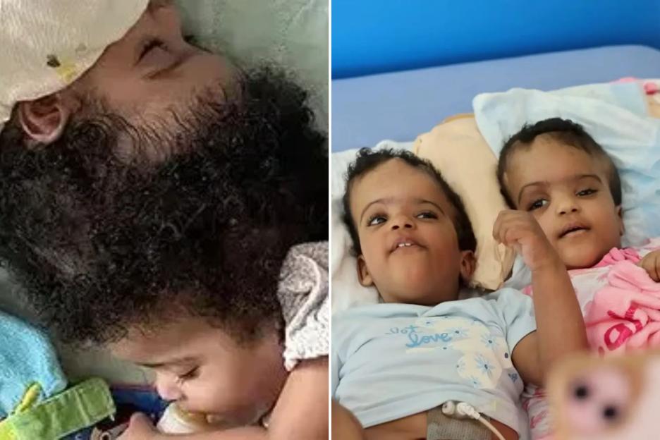 Conjoined twins, 2, attached at head since birth separated in gruelling surgery that took more than 24 hours