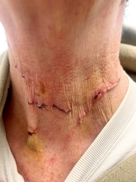 Close-up of healing neck wound with sutures and bruising on pale skin.
